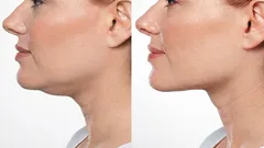 Three simple facial exercises to reduce double chin at home